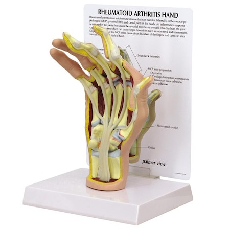 Anatomical Model - Hand - Rheumatoidarthritis